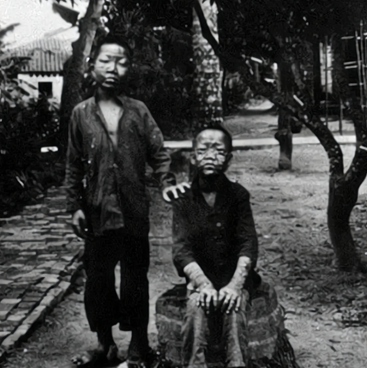 1934年,一名麻风病人,罕见的留影,由于当时医疗条件有限,人们认为麻风