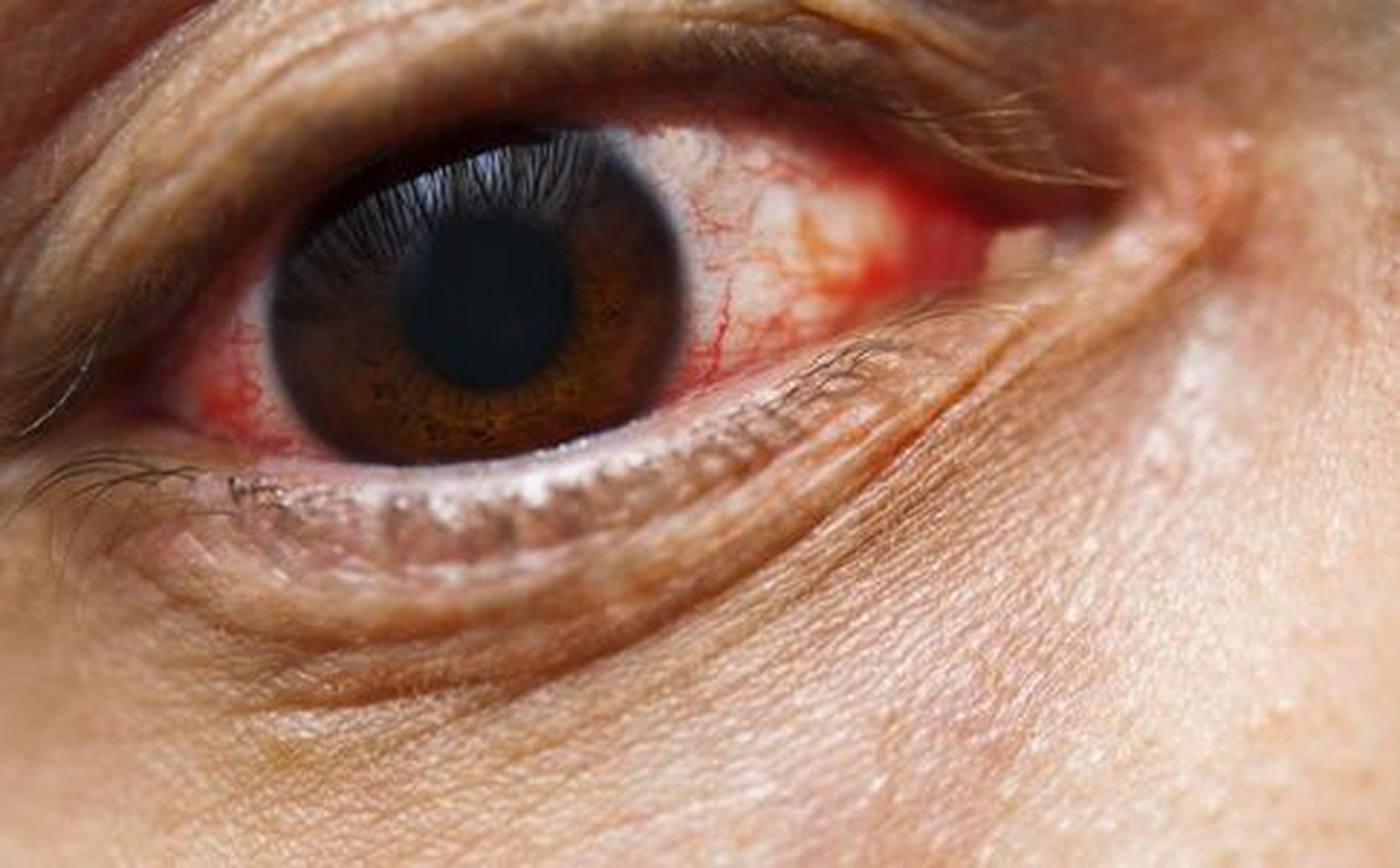 1.16,据悉,国内已检测出多例,患者有结膜炎症状.