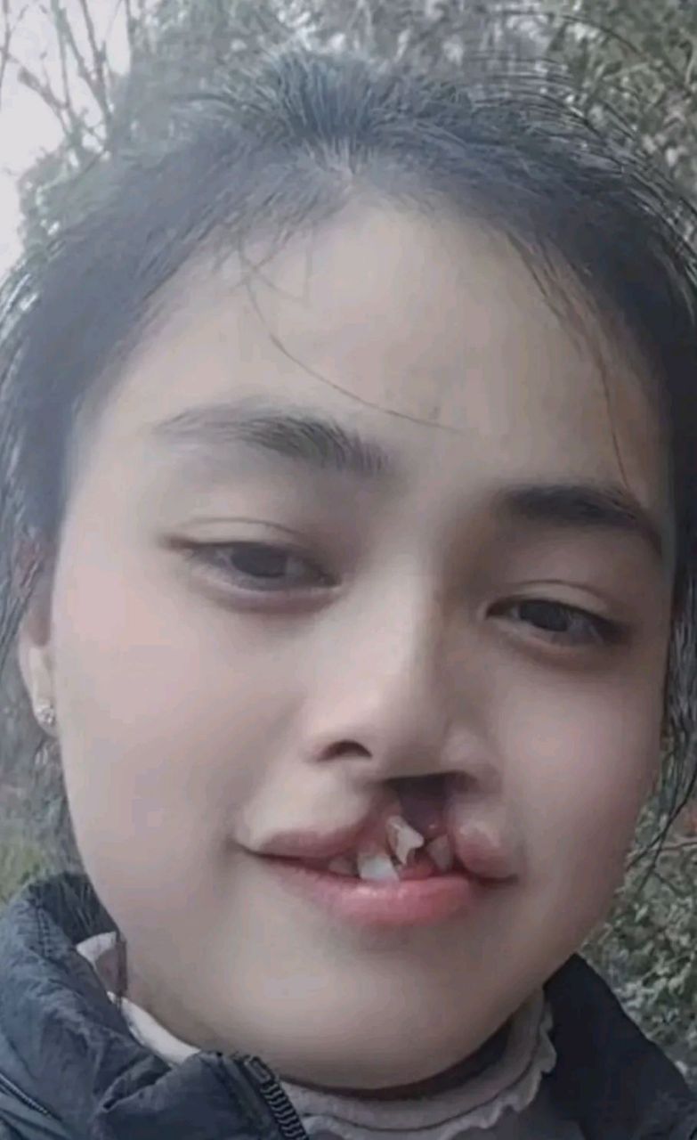 唇裂女孩 这么漂亮的女孩,为什么不选择手术修复呢, 家住四川的一个小
