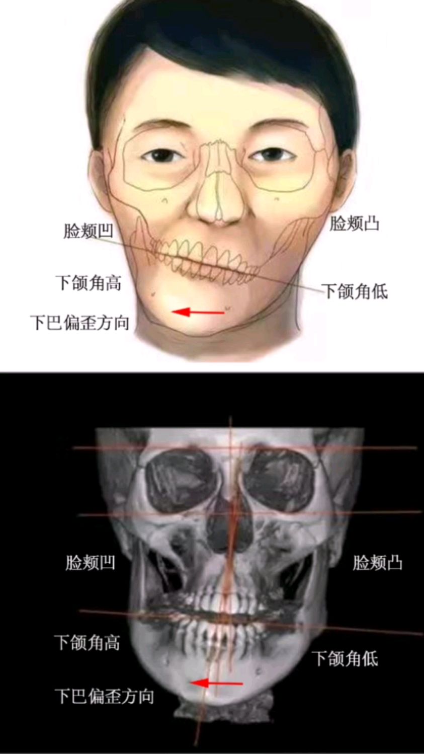 下颌骨不对称一高一低图片