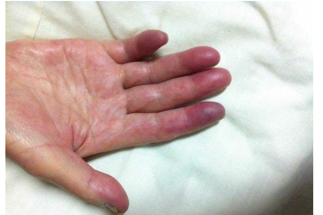 肺不好,手上可能会出现这3个信号,多喝1茶,或可有助养护肺部