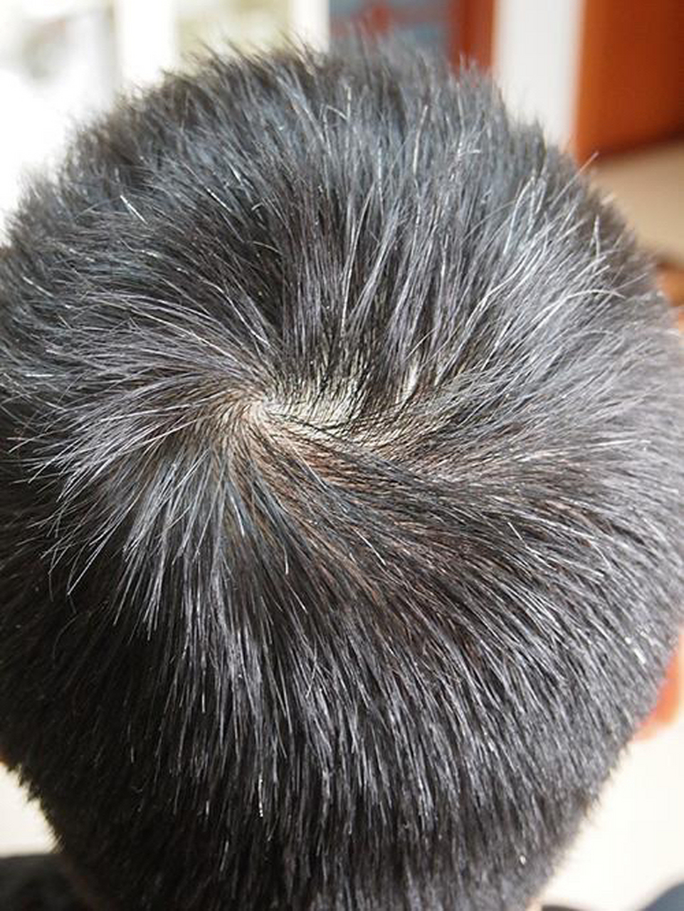 少白头是指青春期时,头发过早变白的现象.