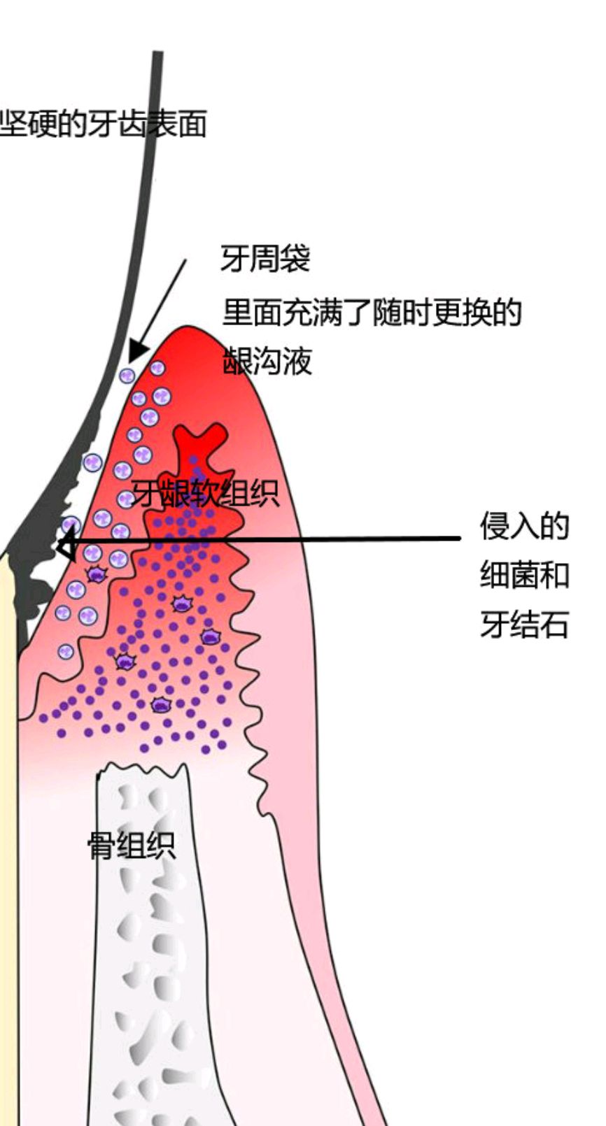 吃药到底能不能治好牙周炎?