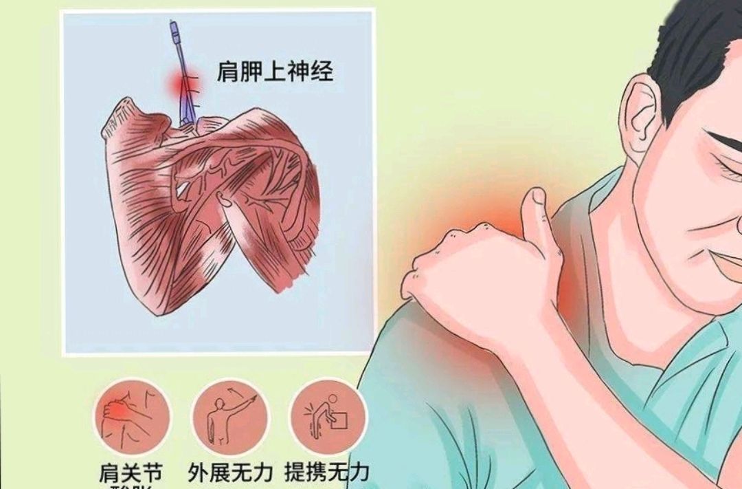 周围神经损伤(六)肩胛上神经损伤