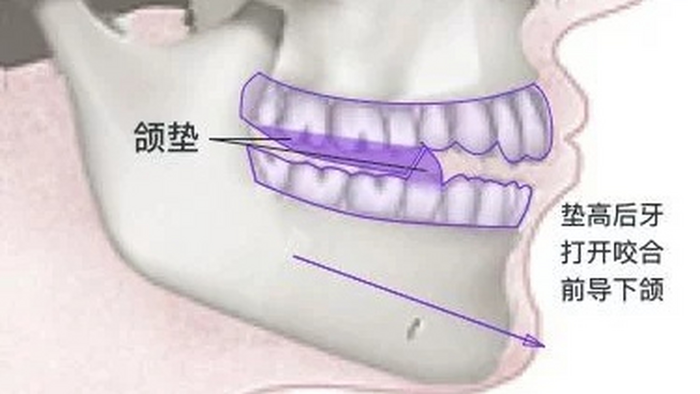 整牙垫高的原因如下:  一,上,下牙咬合过紧或牙冠较短,无法在临床冠