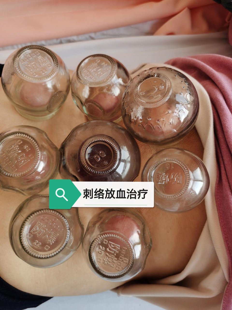 刺络放血治疗