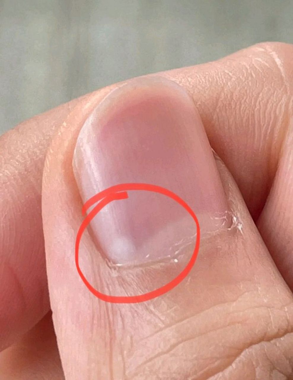 网友:感觉自己身体状况一般吧,指甲月牙上长出来的这个是啥玩意?