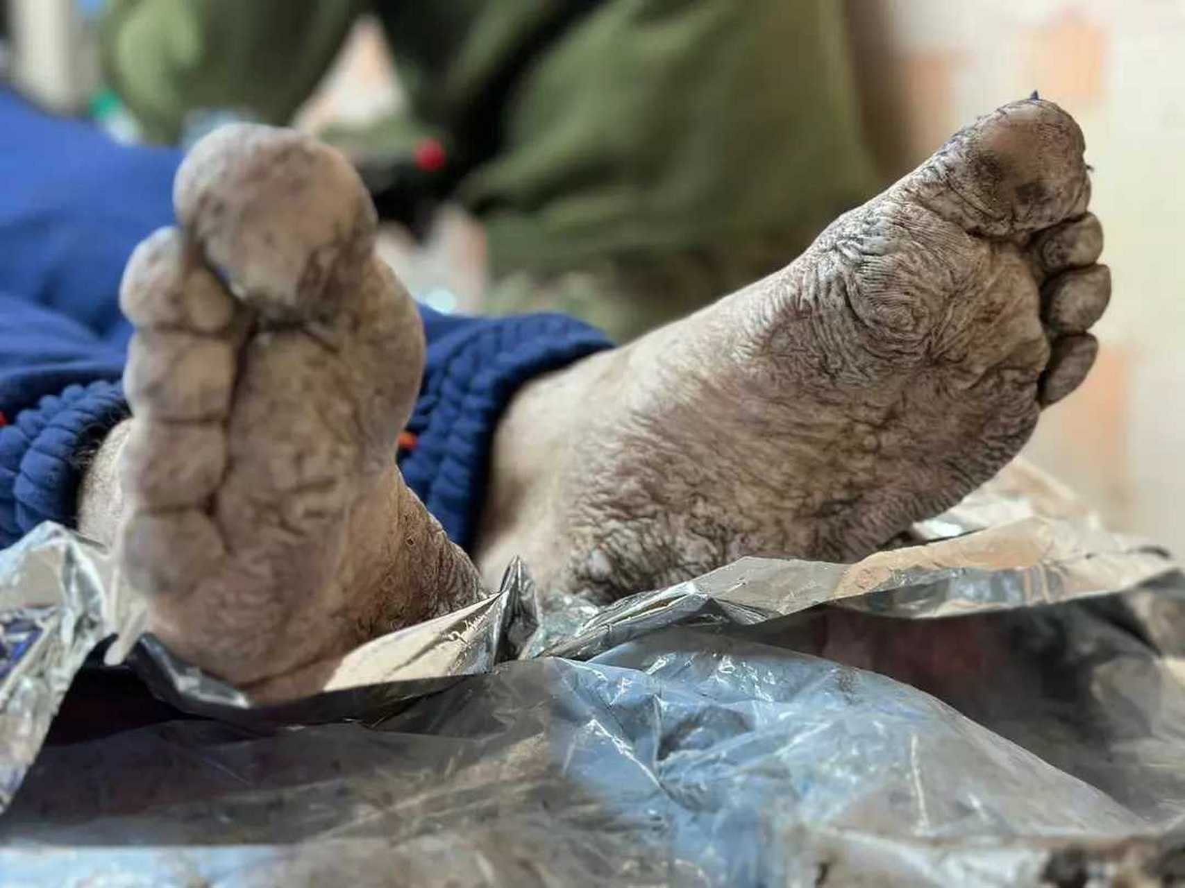 网传乌军士兵的脚,长期在战壕所致!