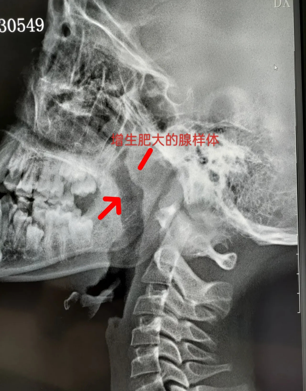 腺样体肥大,在小儿疾病中比较常见,张开嘴,在咽部的穹窿顶部可以看到