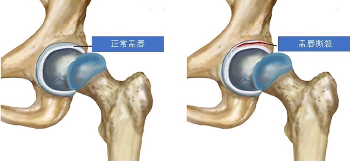 髋关节盂唇位置图片图片