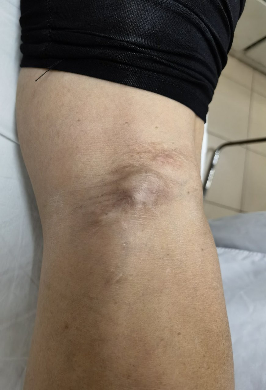 何医生昨天抽了一个腘窝囊肿.