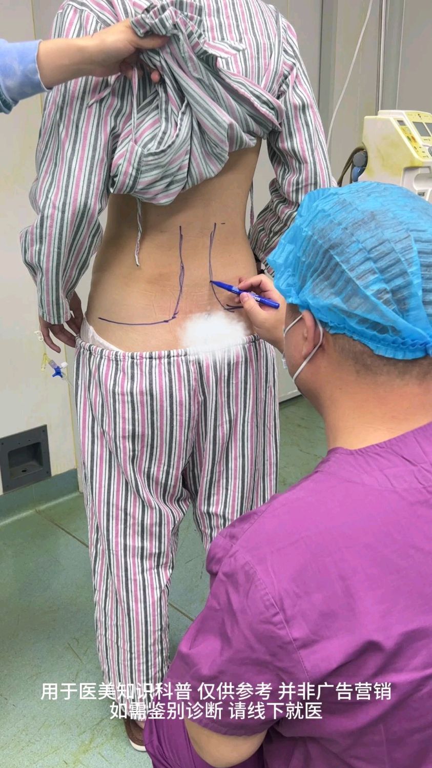 腰腹环吸妈妈臀吸脂术前划线