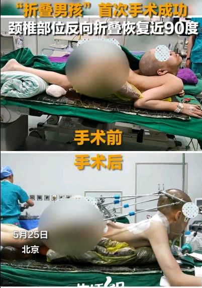 折叠男孩首次手术成功