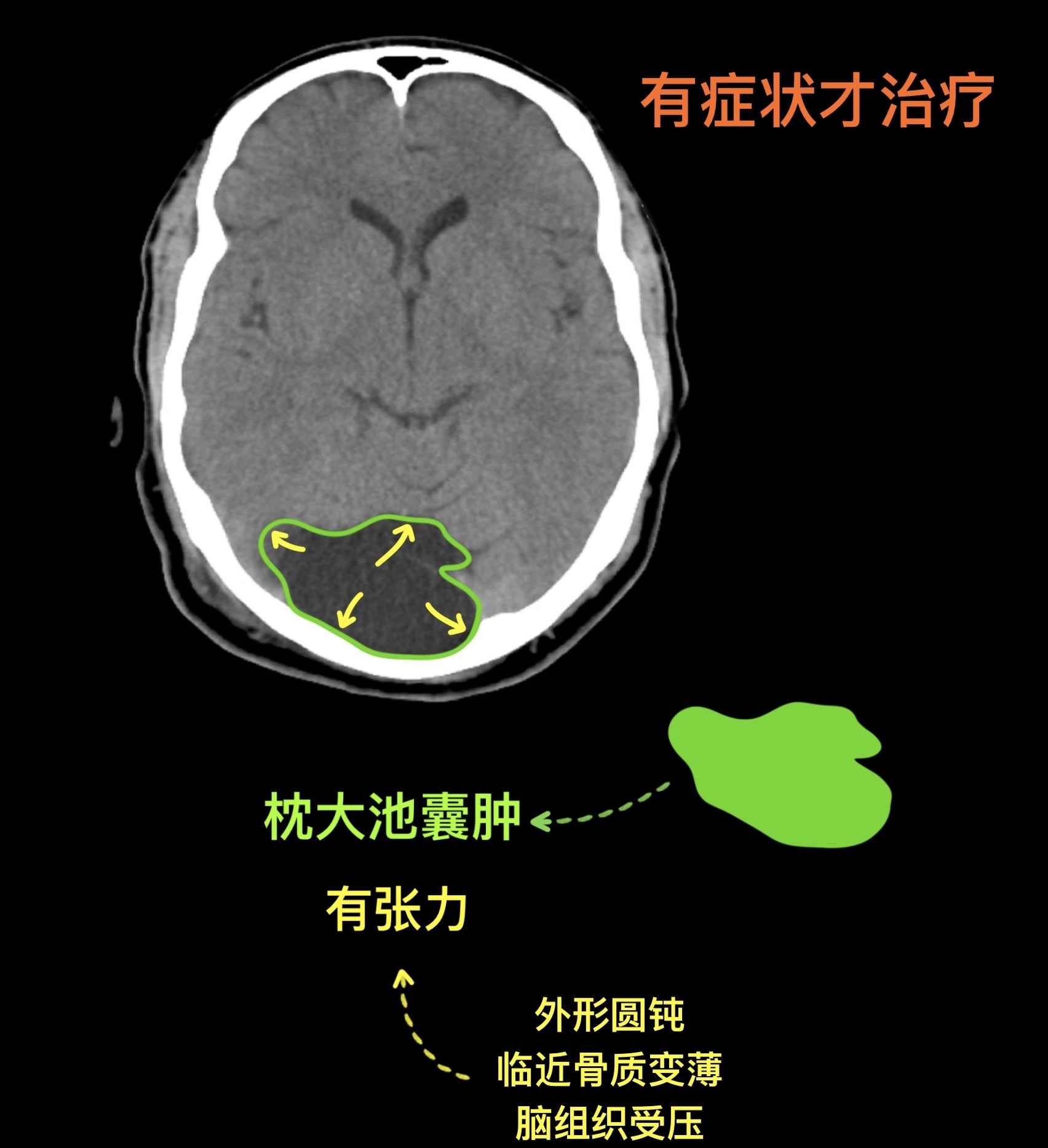 手绘:大枕大池和枕大池囊肿