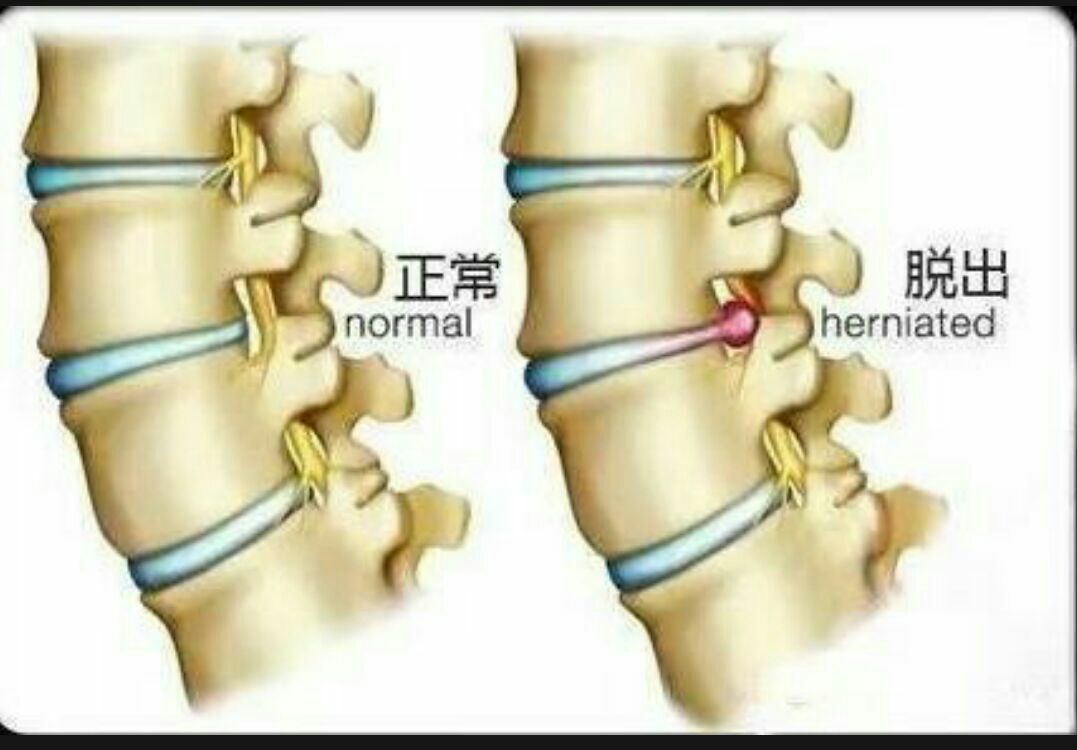 腰椎间突出急性期腰椎压迫脊神经可导致神经水肿