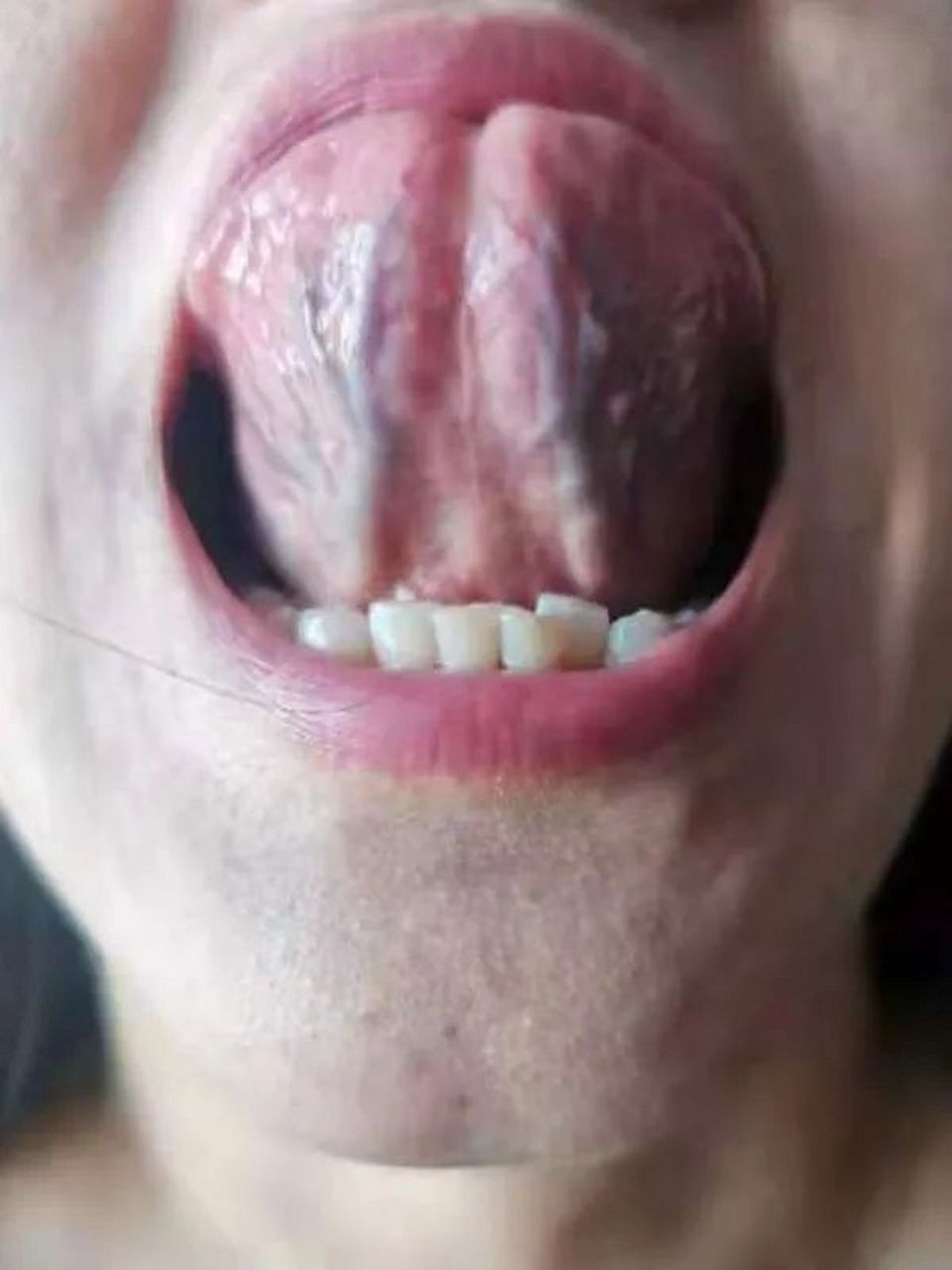 第1种正常的舌头:  舌下青筋一般淡青色的.