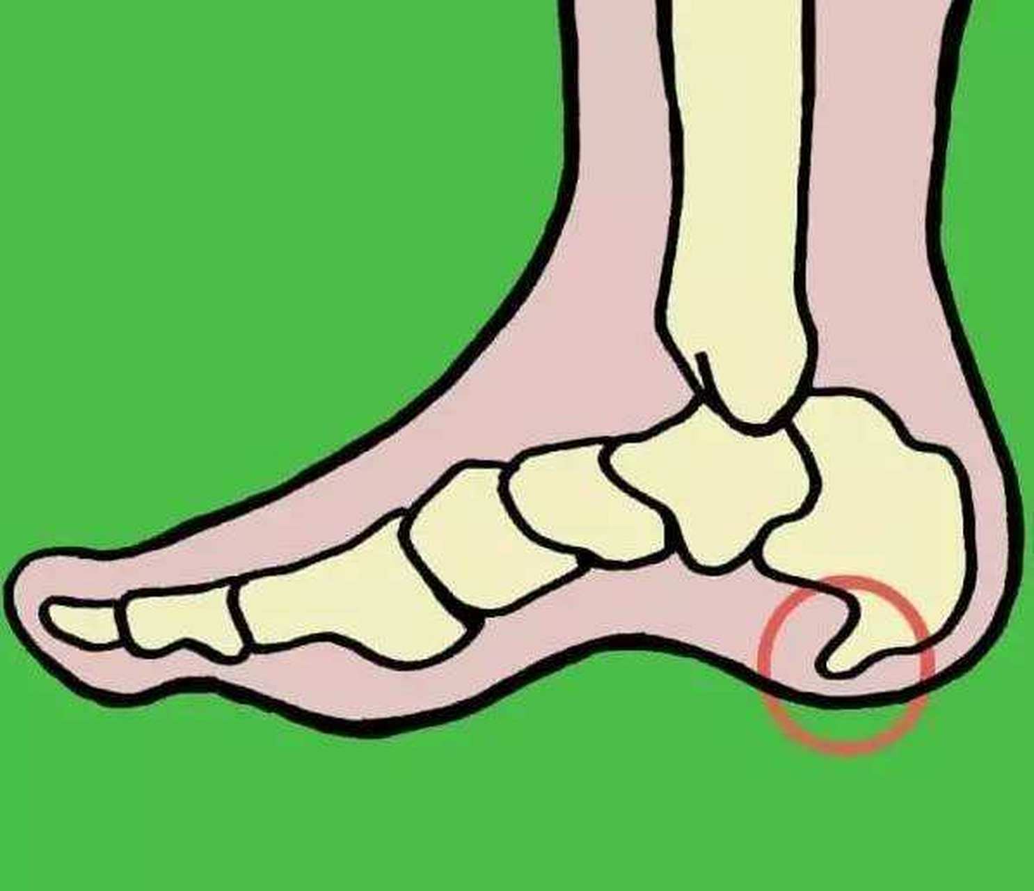 足跟骨刺用芥面醋外敷能彻底治愈   我是足根骨刺患者 ,秋冬天气变化