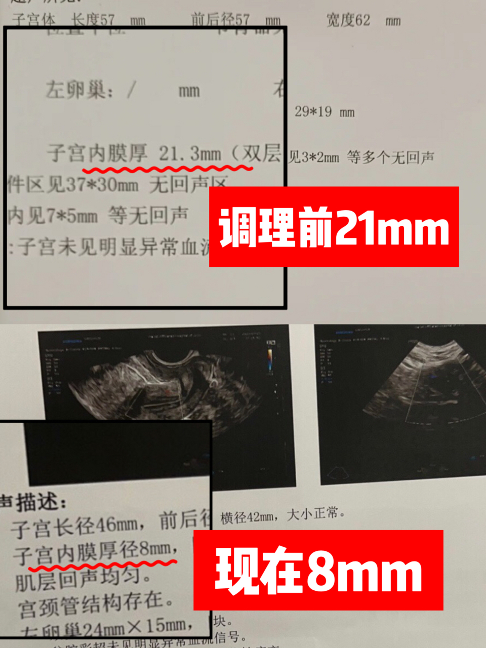 子宫内膜厚,月经淋漓,交给中医45天,没让患者失望,厚度真的变薄了!