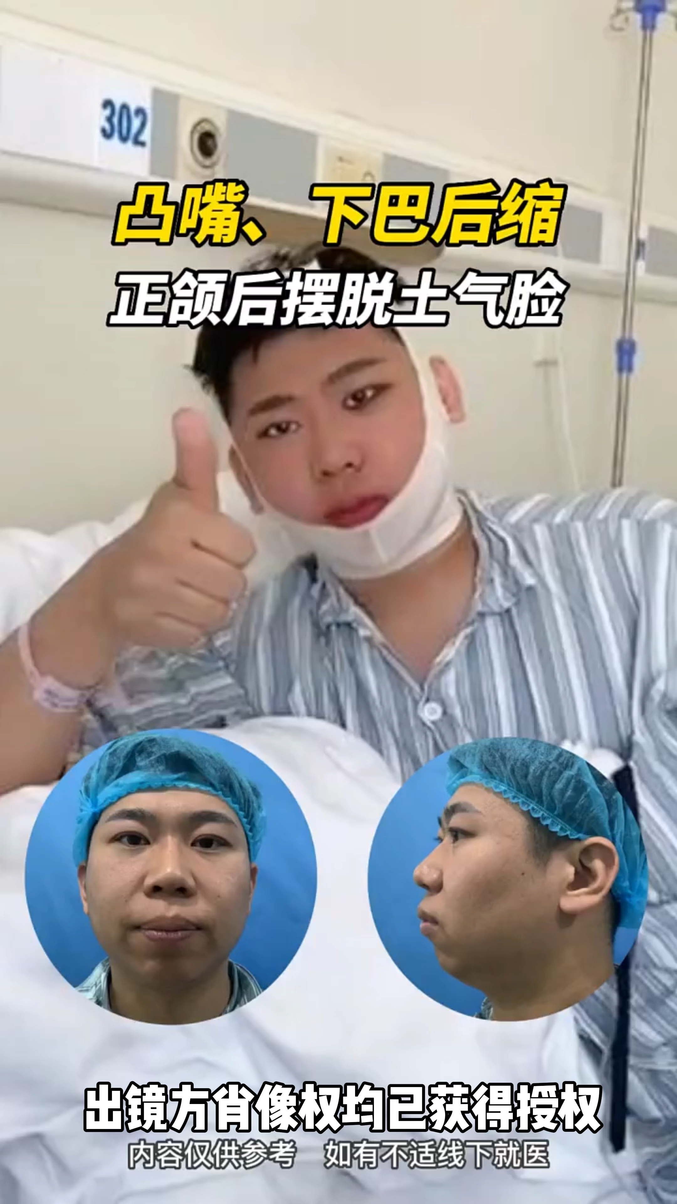 凸嘴下巴后缩,正颌后摆脱土气脸