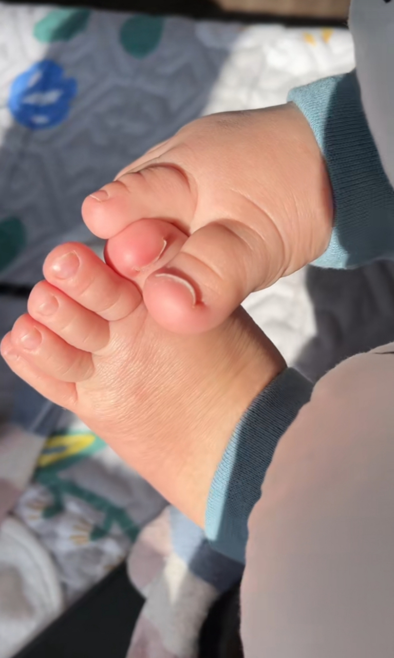 有跟我家宝宝脚指甲一样往上翻的吗,要不要去医院矫正啥的啊!