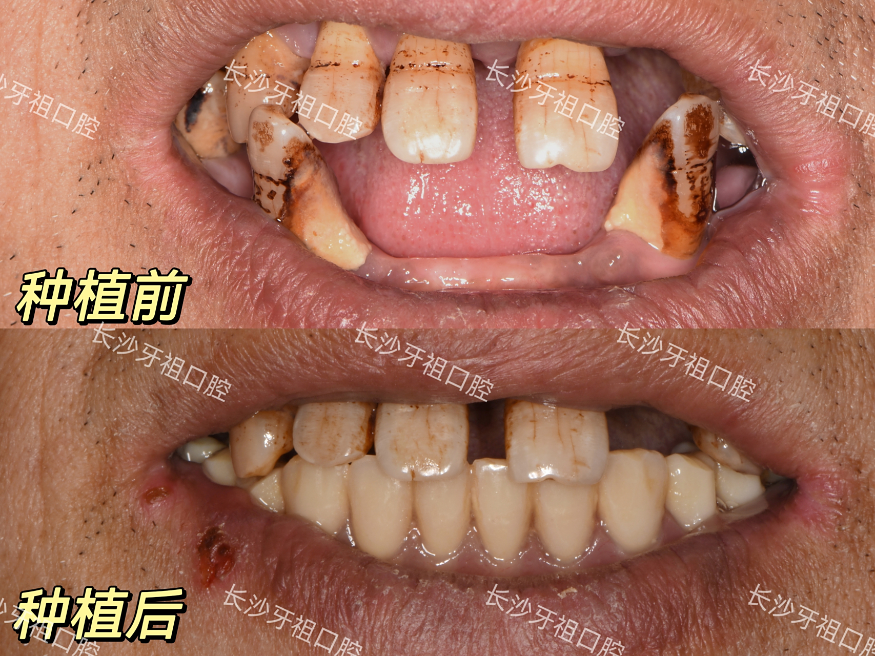 牙齿健康# #种植牙# 半口牙种植案例!
