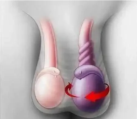 反复阴囊坠胀感或疼痛,触摸阴囊发现附睾肿大,变硬,怎么回事?