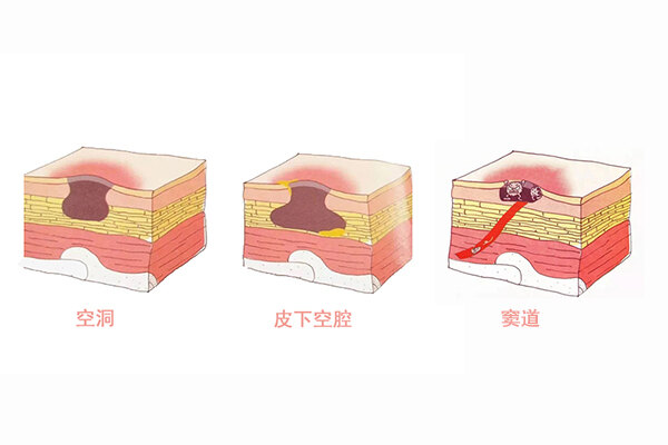 伤口愈合形成空腔图片图片