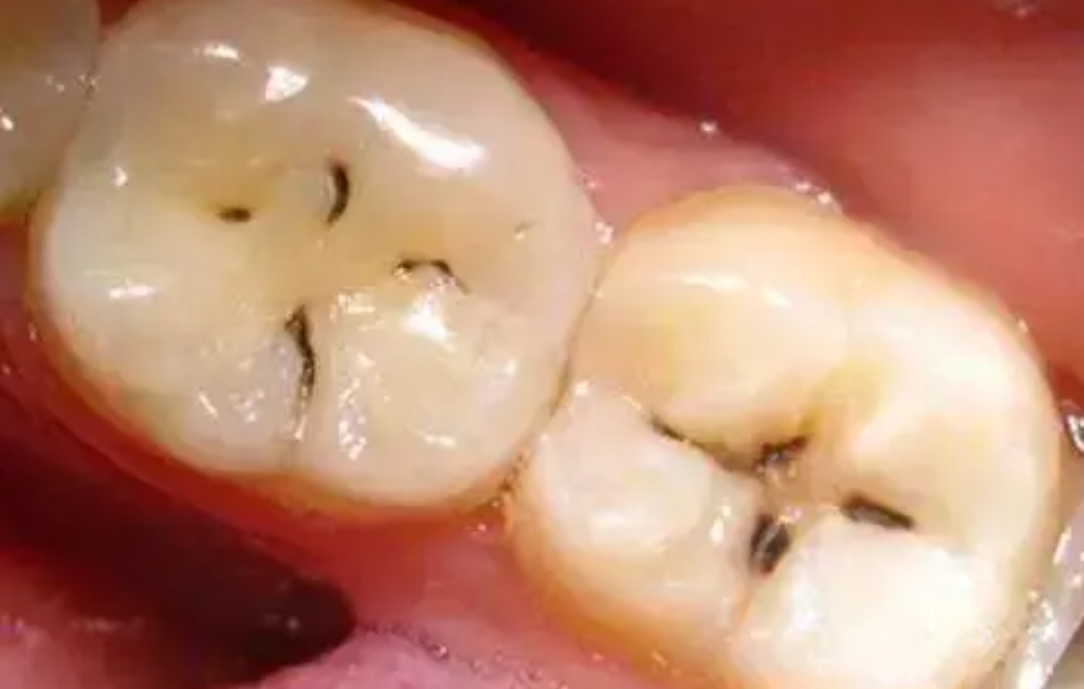 牙缝上冒出"黑线",先别着急用手抠,这样做牙齿或会越来越健康