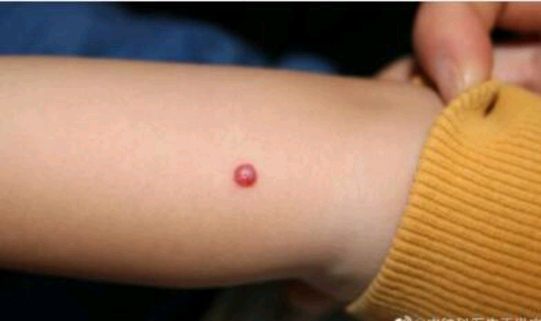 这个小红点,也叫化脓性肉芽肿,本质上还是属于血管瘤