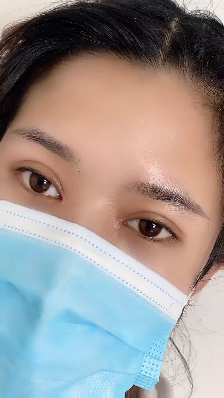 全切双眼皮 两个月是不是很自然-度小视