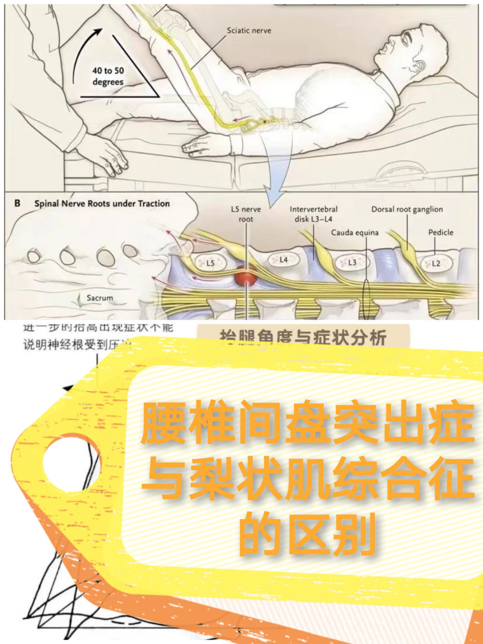 梨状肌综合征位置图片图片