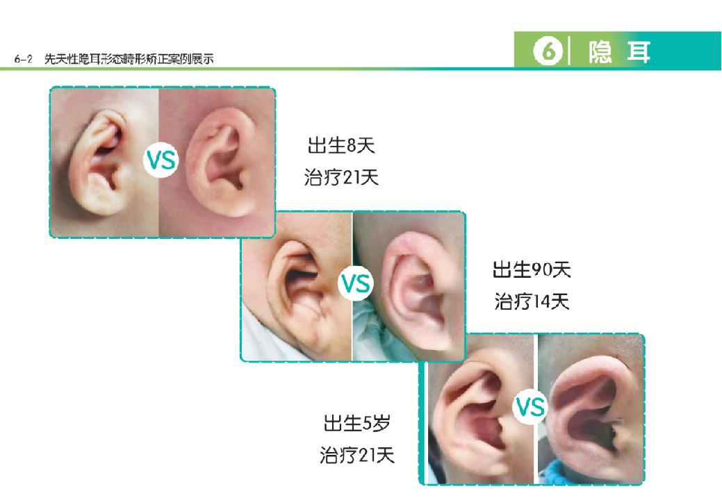 新生儿先天性耳廓畸形的筛查及治疗流程