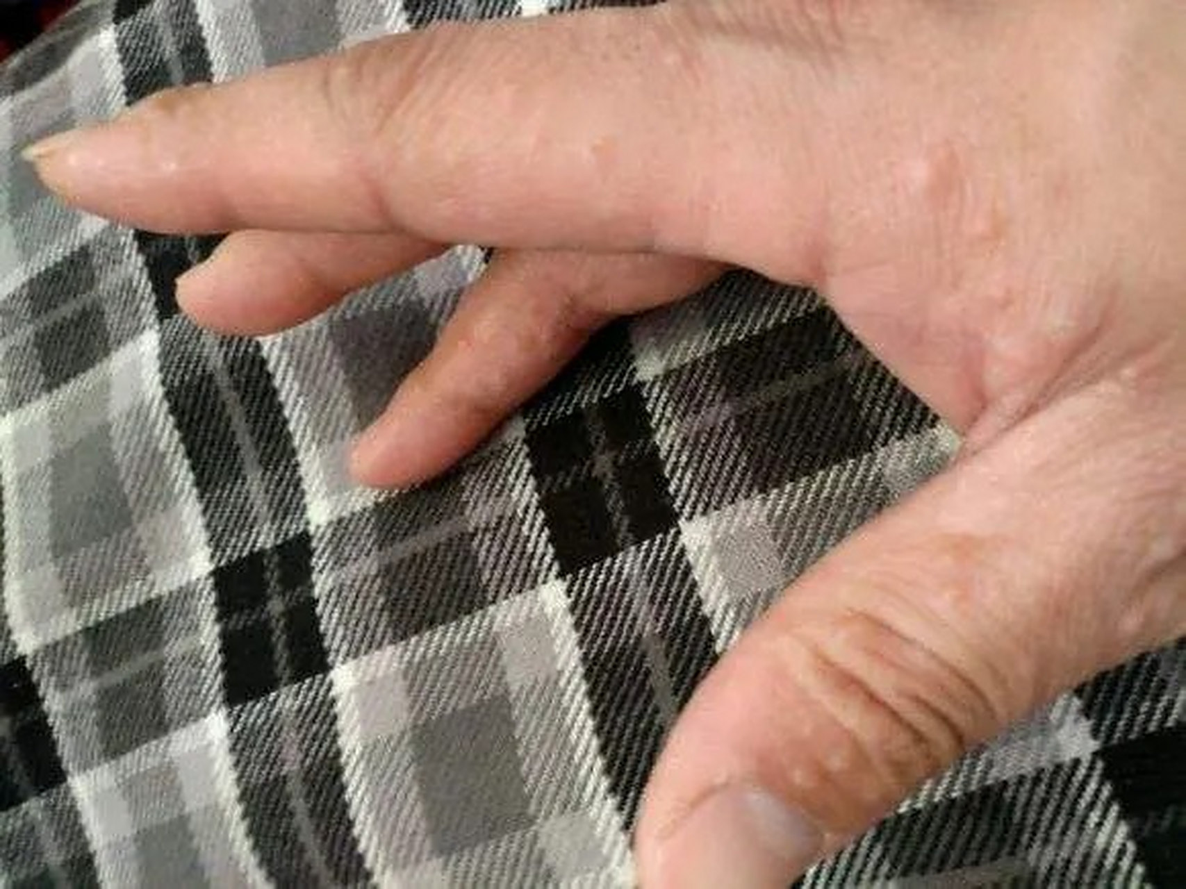 很多朋友的手上每年都会长"水泡", 其实这是湿气的一种,汗疱疹.