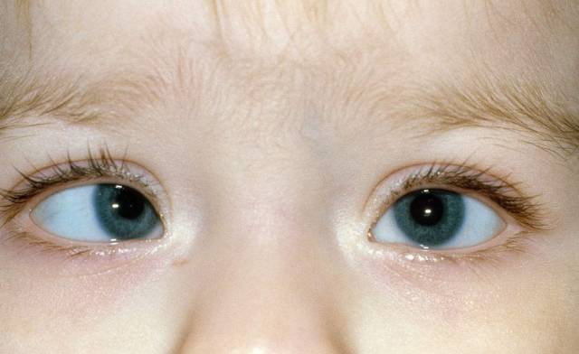 小儿对眼(即小儿内斜视)