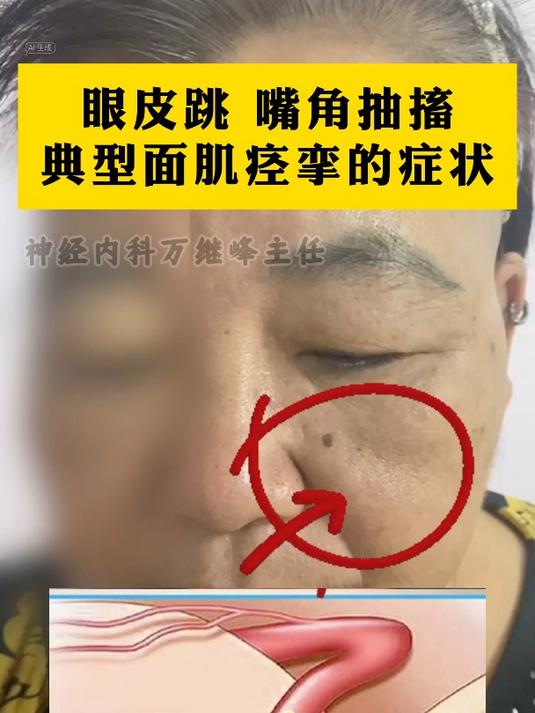 眼皮跳 嘴角抽搐 典型面肌痉挛的症状