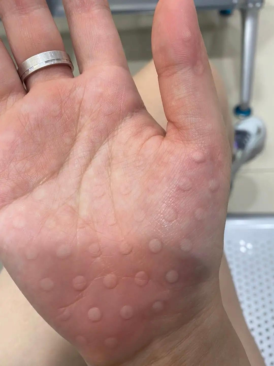 我该怎么办?一觉醒来手上长了好多小疙瘩,应该挂皮肤科还是外科呢?