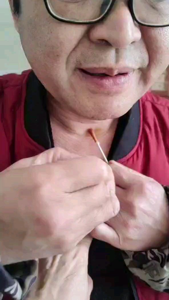 久咳,自己针灸自己天突穴,效果杠杠的!