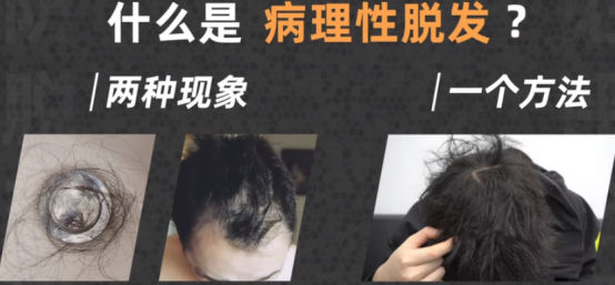 病理性的脱发三大表现,看看你中招没?