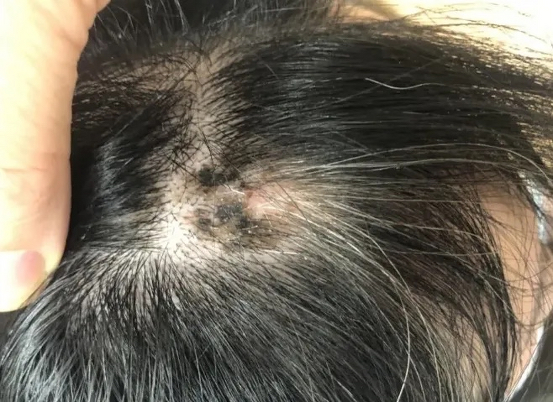 昨天我帮公公洗头,发现他头上有一个黑痣,表面溃烂,但按下去不痛不痒.