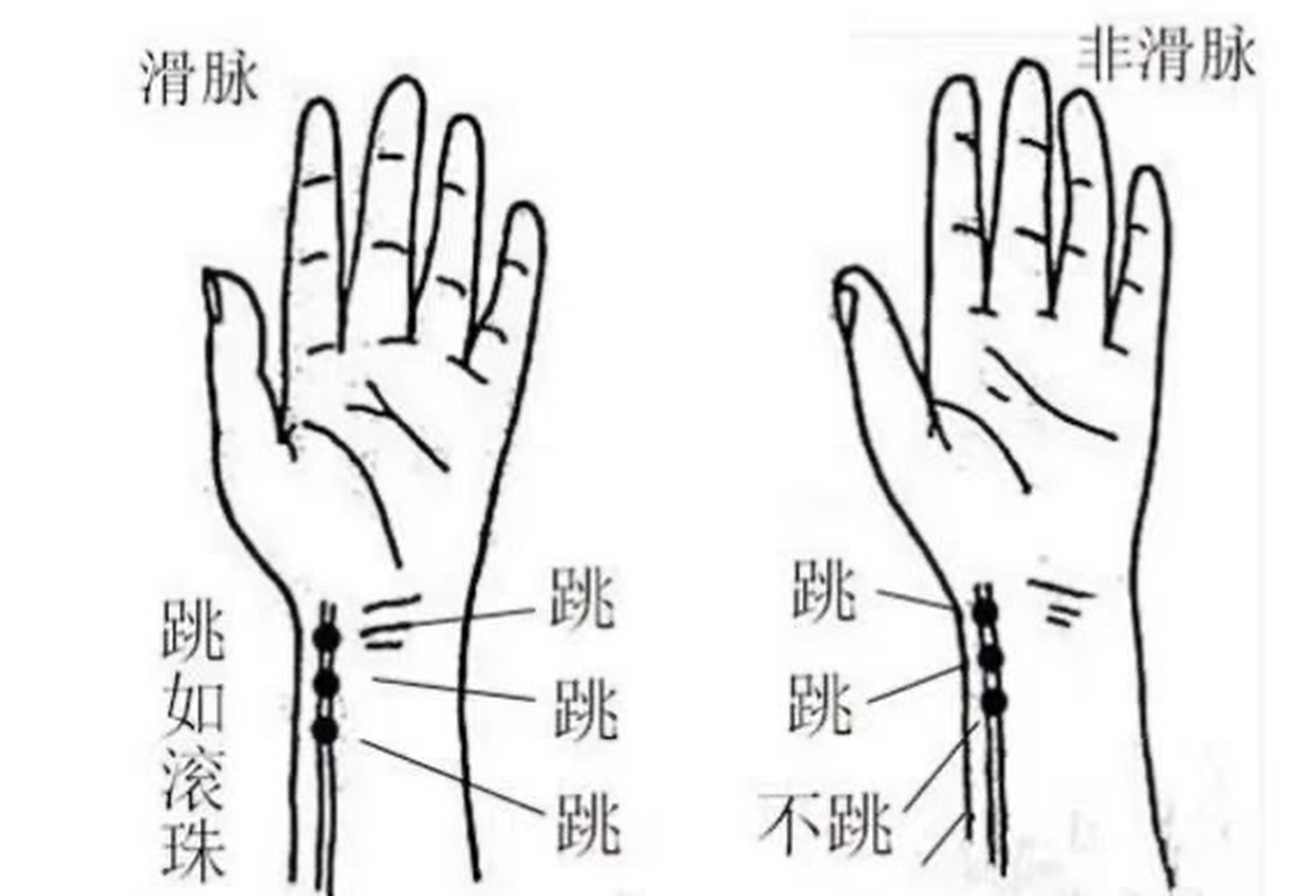 诊脉可辨怀孕,可辨男女 判断是否怀孕的脉象:  一