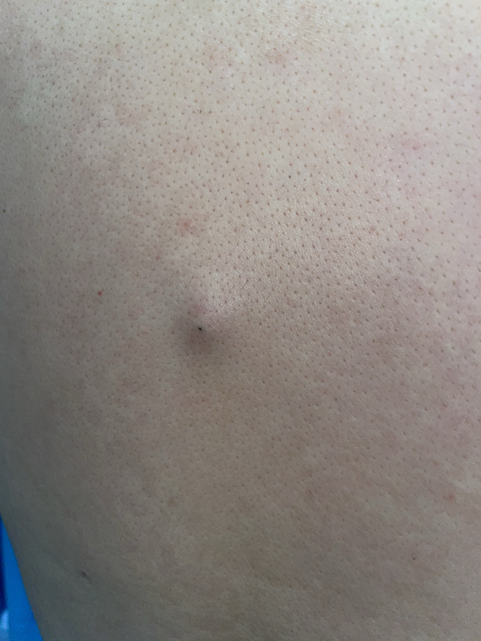 后背部的这种良性的皮肤肿物,中间有个小眼,这个就是表皮囊肿,民间