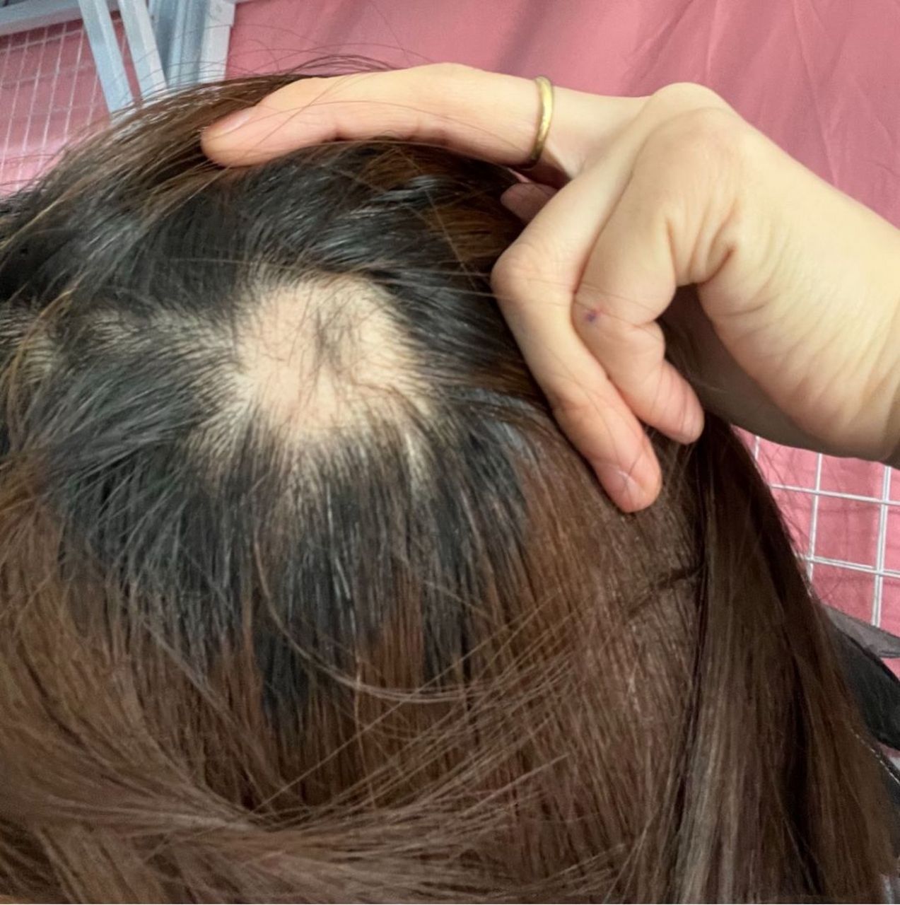 才20岁就秃成这样了,该怎么找对象啊!