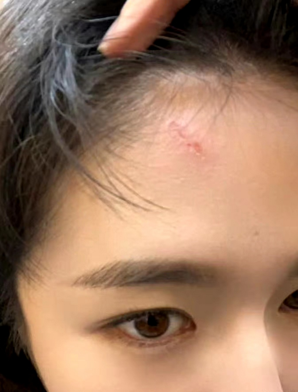 李兰迪额头被砸破皮了,女明星重颜值,李兰迪穿学士服照毕业证,本来挺