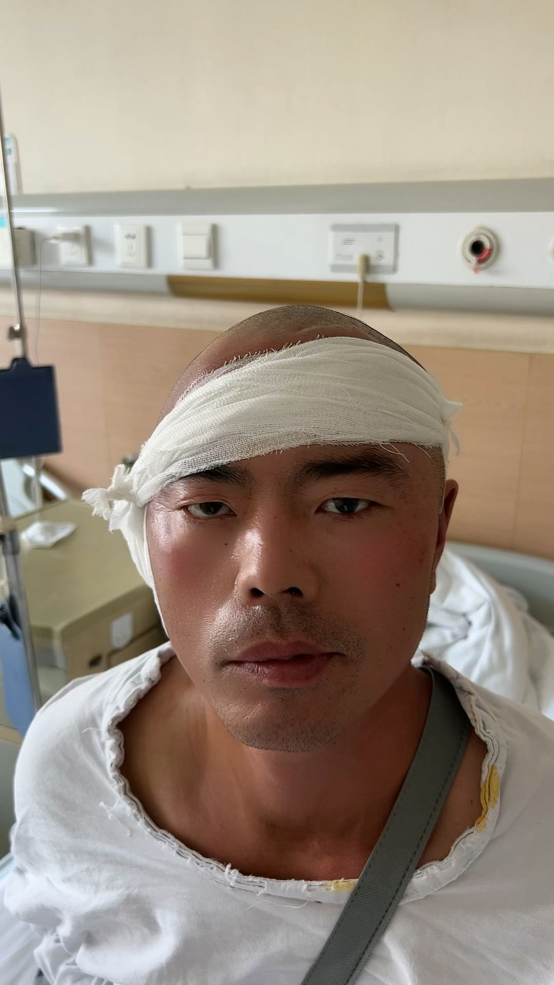 外伤性面瘫面神经减压术后第一天