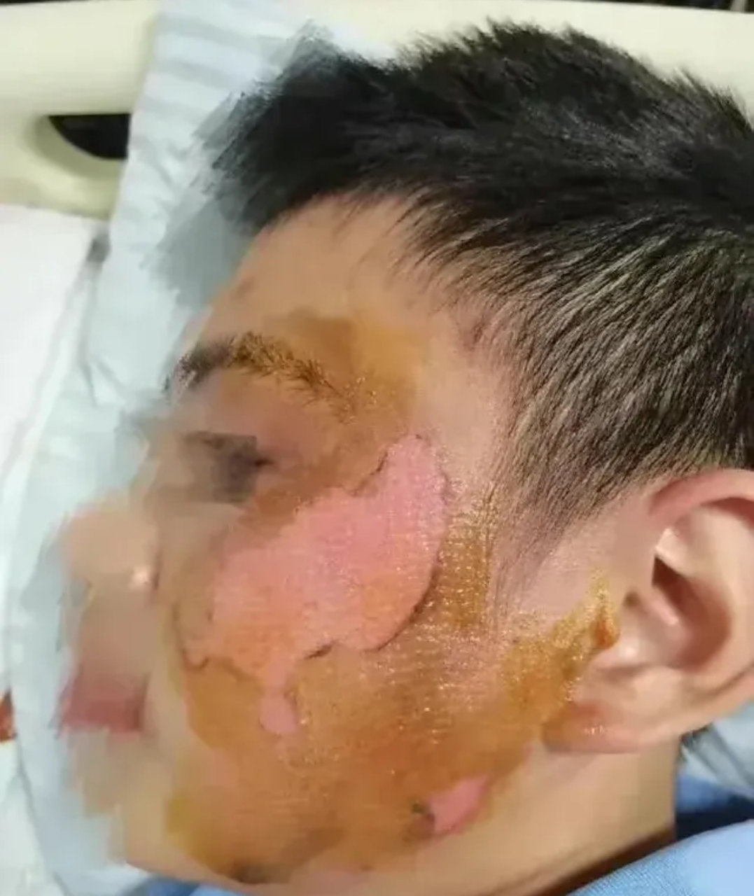 一名13岁的厦门男孩遭同学泼洒100°c开水,面部遭二级烧伤