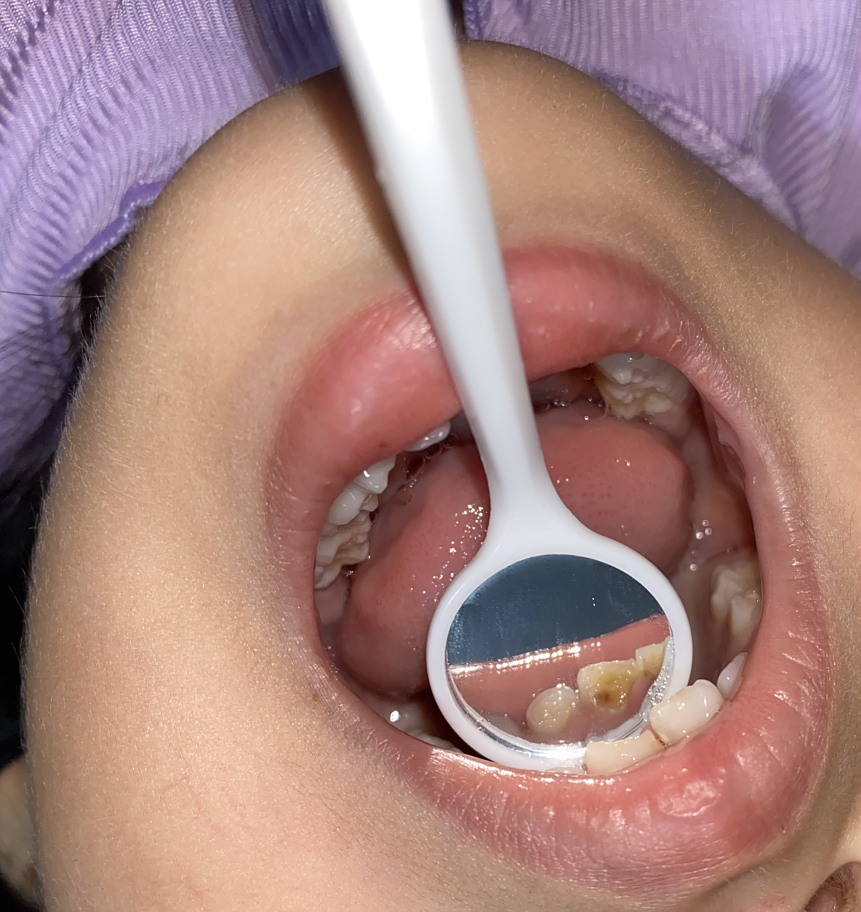 你们的小宝贝牙齿上面也会有这种东西吗?