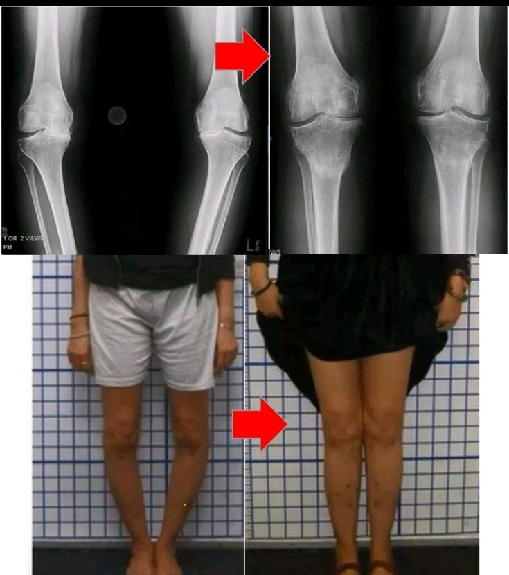 膝盖骨骺线闭合区别图图片