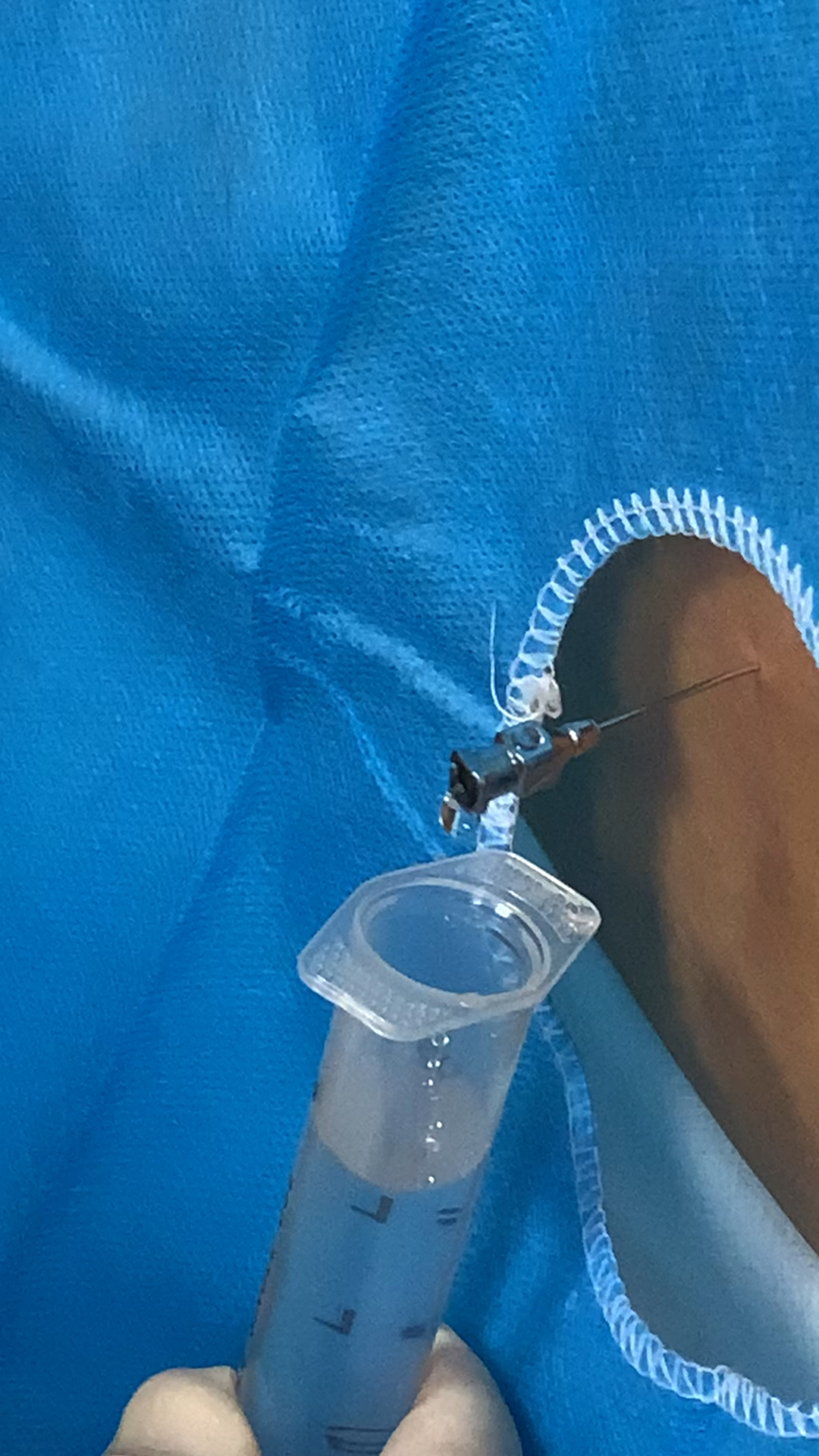 腰椎穿刺释放脑脊液