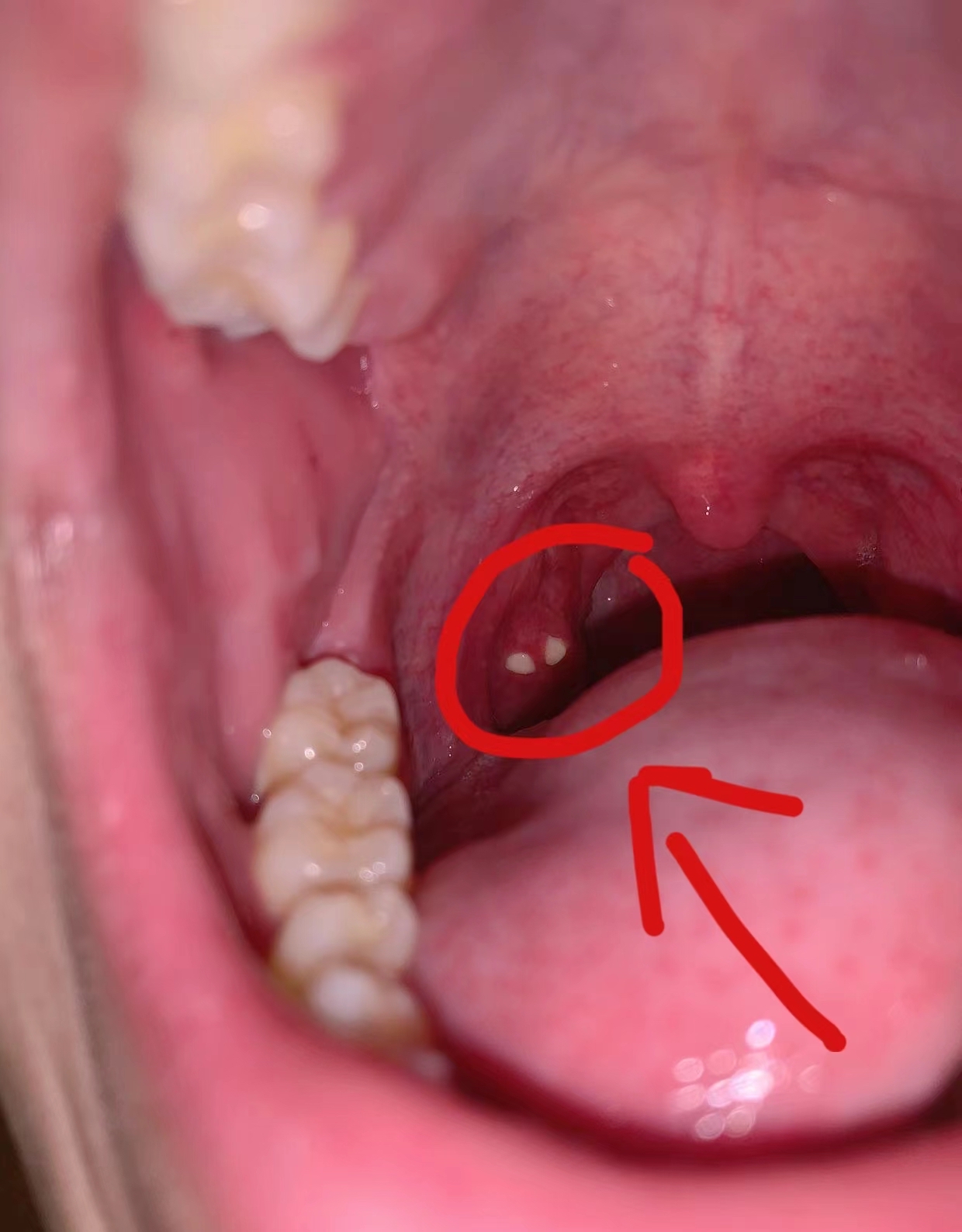 喉咙白色颗粒图片图片