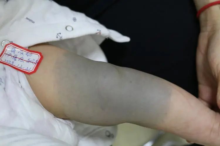 青色胎记是怎么造成的?有什么危害吗?